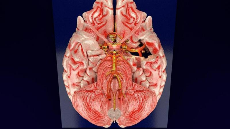 Berry aneurysm circle of willis