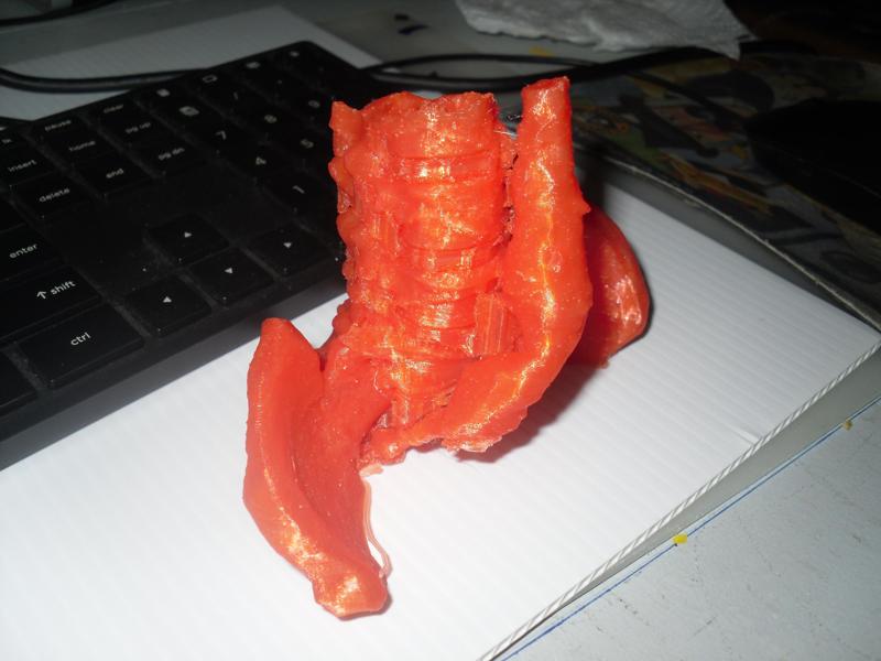 Abdominal aortic aneurysm (AAA or triple A)