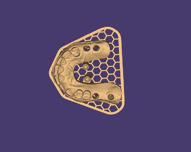 3D Model of Arches on Implants - 8 Elements (Upper and Lower)