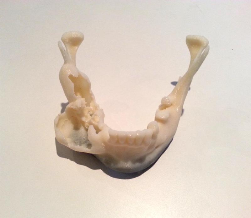 Jaw with Bone Damage due to Tumor