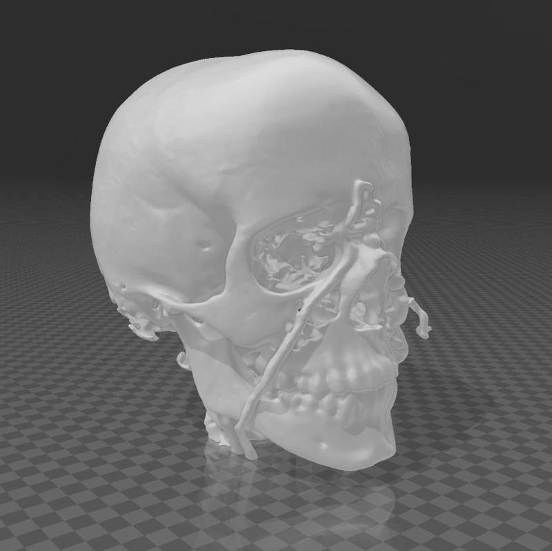 Venous malformation of the brain arteries