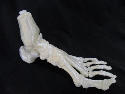 Ankle - Talus fracture