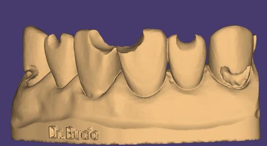 Cavities anterior teeth