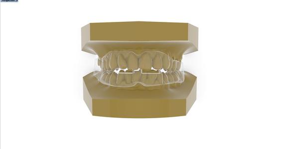 Digital Anti Snoring Splint