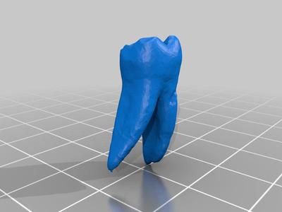 Molar Tooth first lower FDI 36