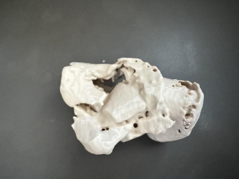 Calcaneus fracture (Sanders 3AB classification)