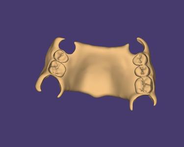 DIGITAL FLEXIBLE PARTIAL DENTURES upper + lower (3D models !!!) - 10 stl files for download