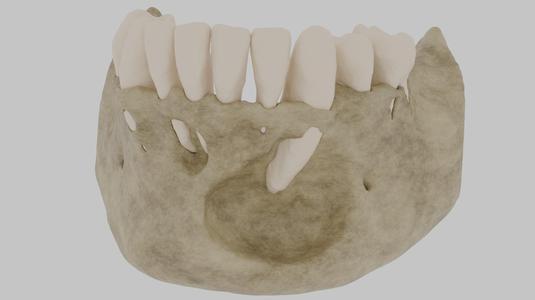 CBCT Periapical Lesions