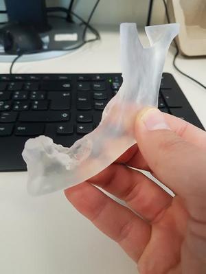 Osteosarcoma of the Jaw