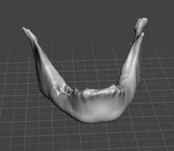 Human mandibule with patology   