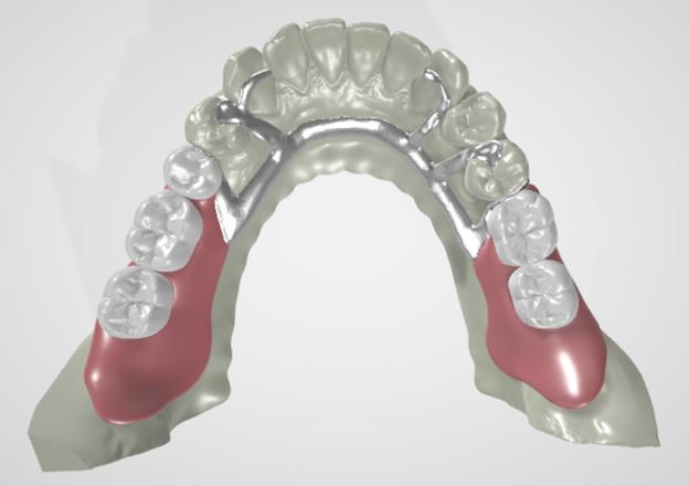 Prosthodontics Kennedy Class I Removable Partial Dentures (Lower Jaw)
