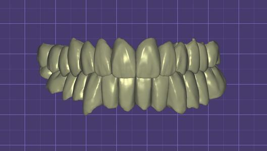 bimax zirconia bridges from 17 to 26 and 36 to 47