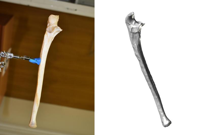 Forearm Bone Scan - Ulna