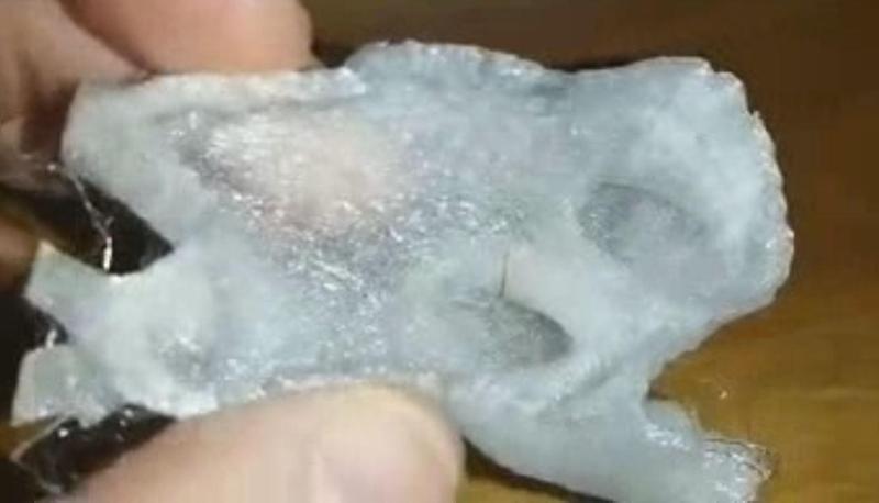 left atrium of the heart: print for occluder implantation feasibility