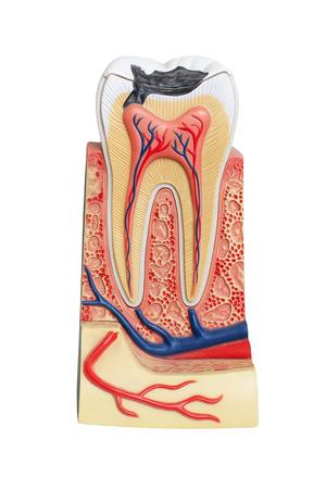 Isolated dentist demonstration caries teeth model. Isolated dentist demonstration caries teeth model on white background.