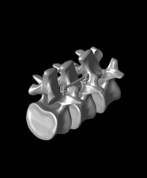 Spondy  double deker pedicle below pars models.stl