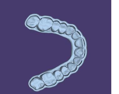 Miorrelaxant Splint for Bruxism - 3D Model for Study and Training