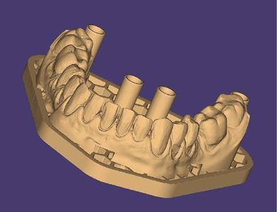 3D Model of Dental Carillas - Upper and Lower Arcades (14-25 / 35-45)