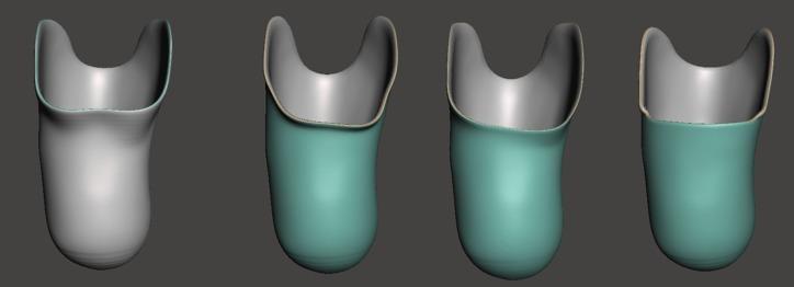 Transtibial (below-knee) Patellar Tendon Bearing Prosthetic Socket (Pack 1)