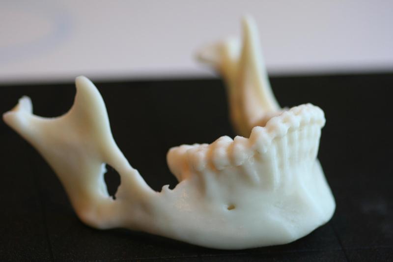 Jaw with Bone Damage