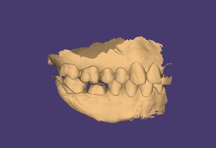 3. INTRAORAL SCANS WITH PREPARATION - 10 REAL PATIENTS, STUDY SCANS, DESIGN PRACTISE (upper jaw, lower jaw + bite scan in every single case)