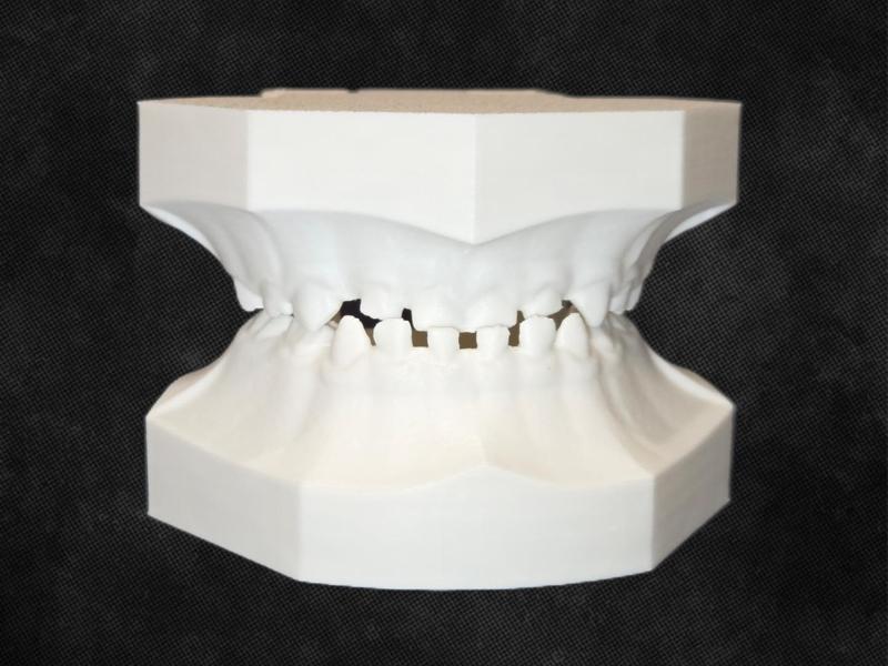 Pediatric Dental Typodont - Underbite Class III