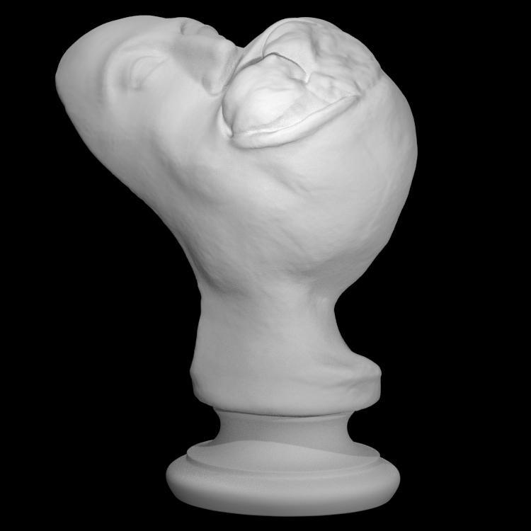 Tumour, fibro-osseous