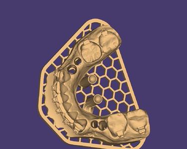 3D Model of Implant-Supported Arches - 8 Elements (Upper and Lower)