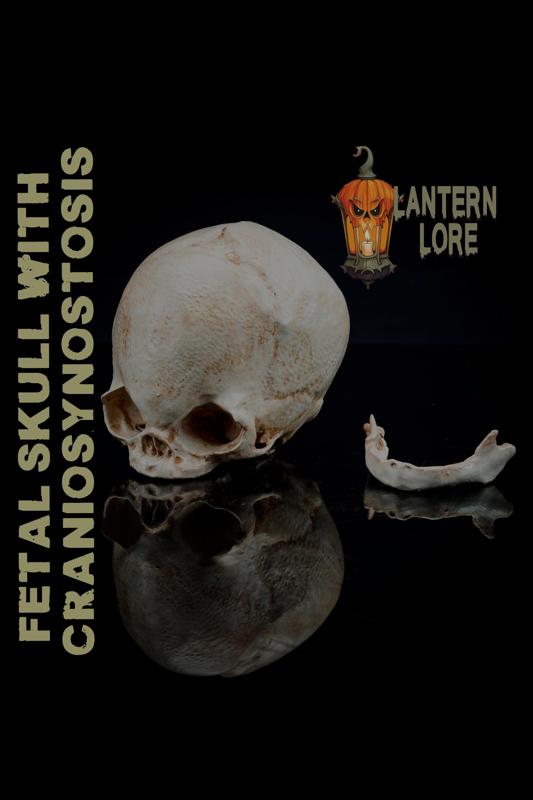 Fetal Skull with Craniosynostosis (Pre Supported)