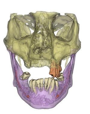 EDENTULOUS PARTIAL MAXILLA AND MANDIBLE