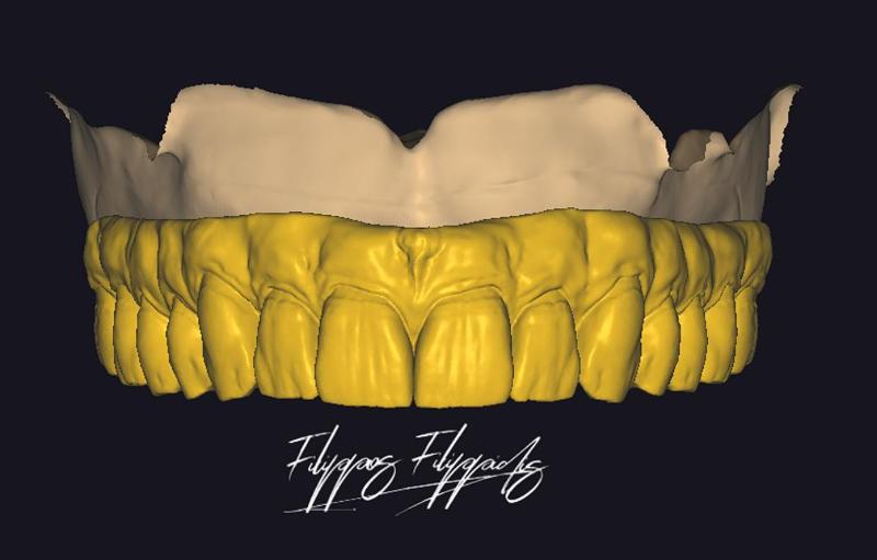 Maxillary Implant design 2 worn