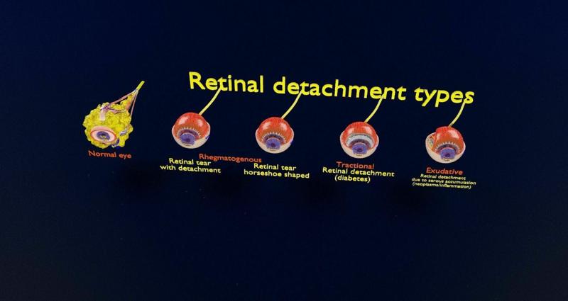 Retinal detachment types eye 3D model