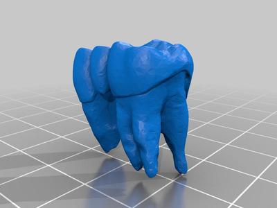 Tooth Bridge / Dentures with Teeth / FDI 14-16
