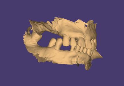 INTRAORAL SCANS FOR RPD/FLIPPER - REAL PATIENTS, STUDY SCANS, DESIGN, PRACTISE (upper jaw,lower jaw + bitescan in every single case)