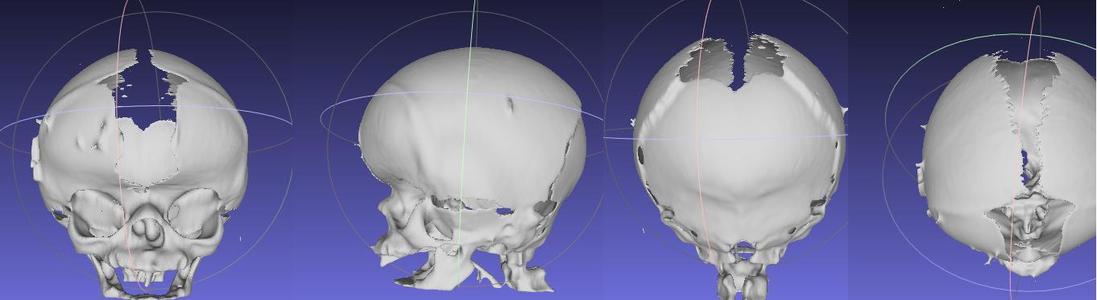 BILATERAL PLAGIOCEPHALY