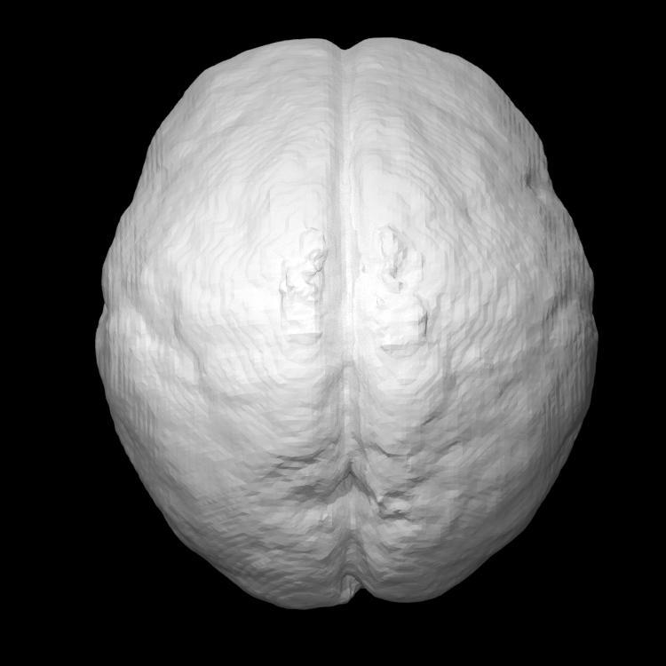 Foetal Brain (14 weeks)