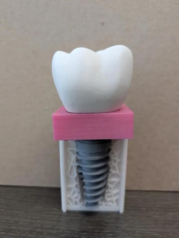 Keon Implant Patient Education/ Dentist Entertainment Model   