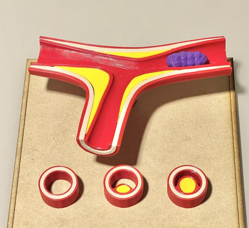Atherosclerosis educational model