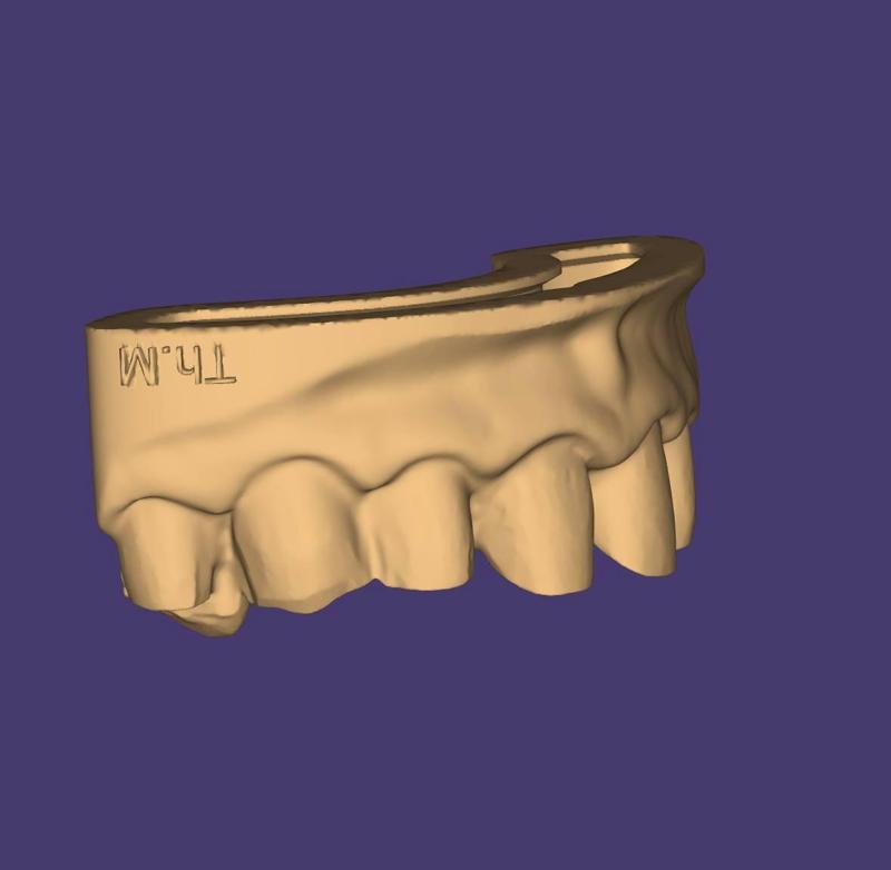Dental training Model Upper Direct Veneers