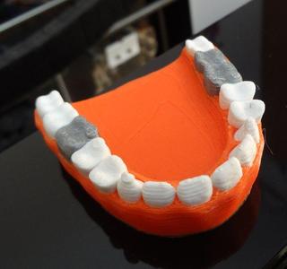 Teeth with a silver teeth prothesis