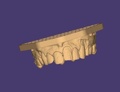 3D Model of Dental Veneers - Upper and Lower Arches (14-25 / 35-45)