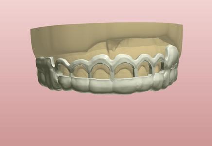 Digital Gingivectomy Guide
