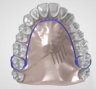 CRIB HABIT BREAKER WITH SPIKES DENTAL APPLIANCE ON UPPER TEETH