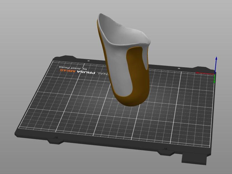 Transfemoral (above-knee) prosthetic (single-walled) sockets