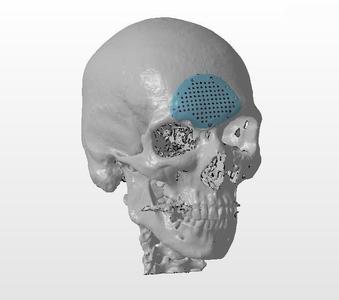 A cranial plate to replace a skull defect (an example of a real operation 2)