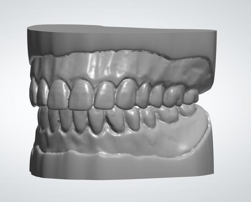 Denture study models