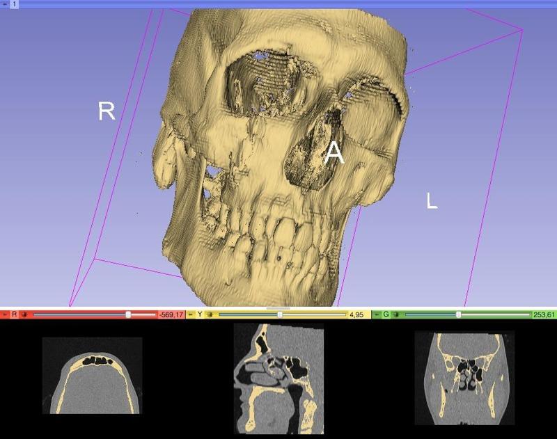 Human Skull (front halve)