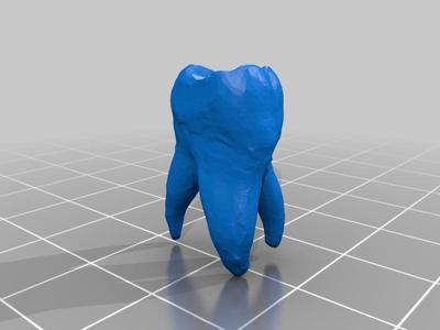Tooth with decay, Upper first molar FDI 26