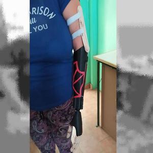 Hope#1 prosthesis LEFT ARM based on flexy hand form Jorge 
