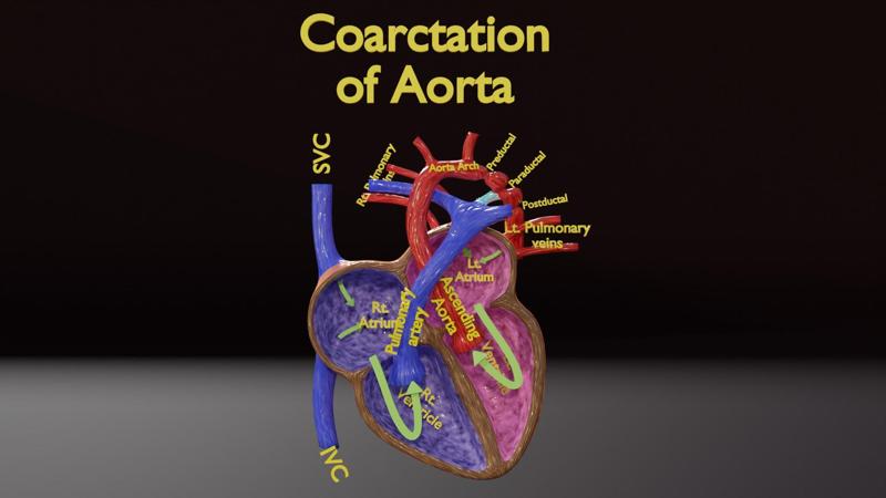 COA Coarctation of Aorta